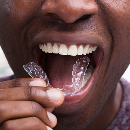 invisalign costs