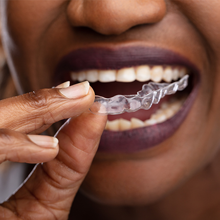 invisalign videos